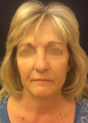Incisionless Necklifts
