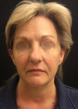 Incisionless Necklifts