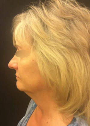 Incisionless Necklifts