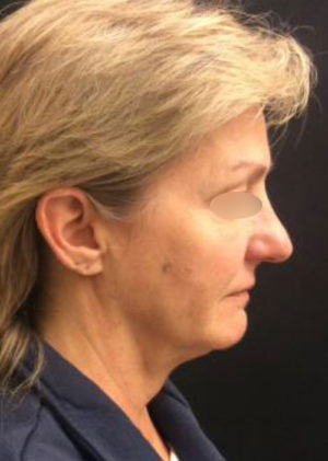 Incisionless Necklifts