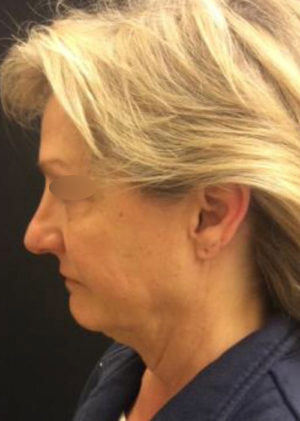 Incisionless Necklifts
