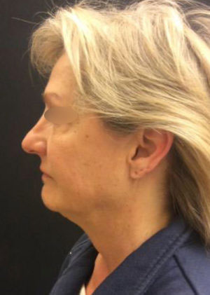 Incisionless Necklifts