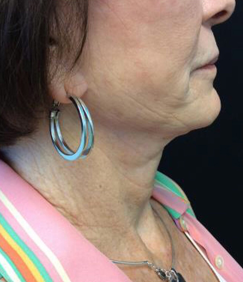 Incisionless Necklifts