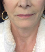 Incisionless Necklifts