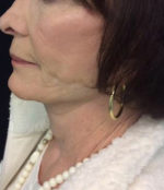 Incisionless Necklifts