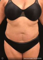 Smartlipo
