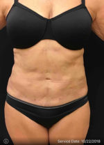 Smartlipo