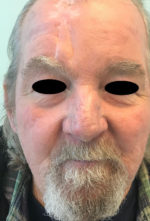 Nasal Reconstruction