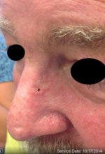 Nasal Reconstruction