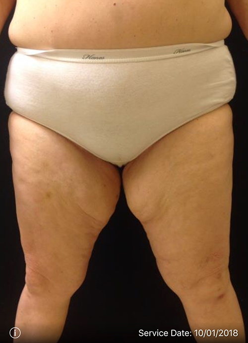 Thigh Lift