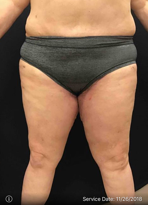 Thigh Lift