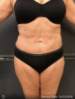 Smartlipo