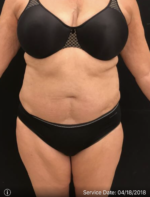 Smartlipo