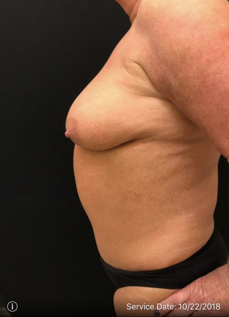 Fat Grafting to Breast