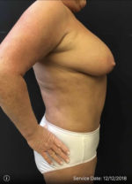 Fat Grafting to Breast