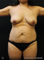 Mommy Makeover