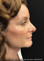 Nose