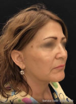 Nouveau Lift