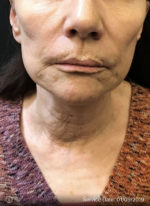Facetite