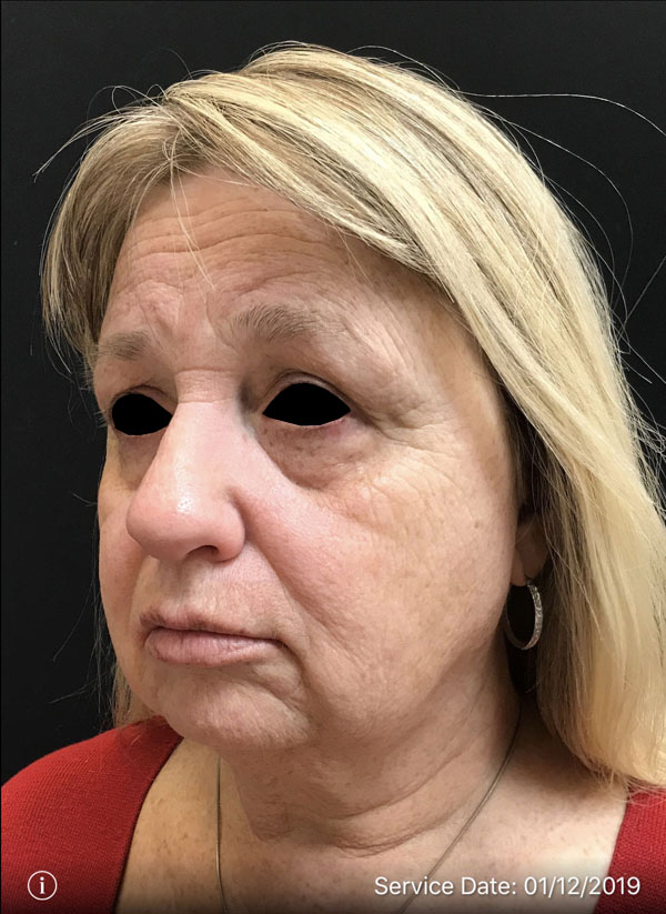 Facelift