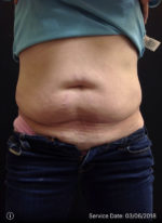 CoolSculpting