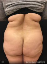 Brazilian Butt Lift