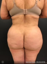 Brazilian Butt Lift