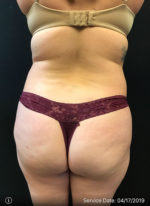 Brazilian Butt Lift