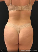 Brazilian Butt Lift