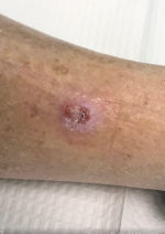 Squamous Cell Carcinoma