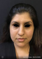 Around The Eye Fillers