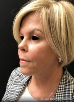 Facetite