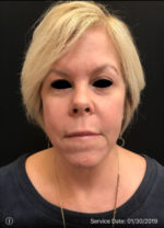 Facetite