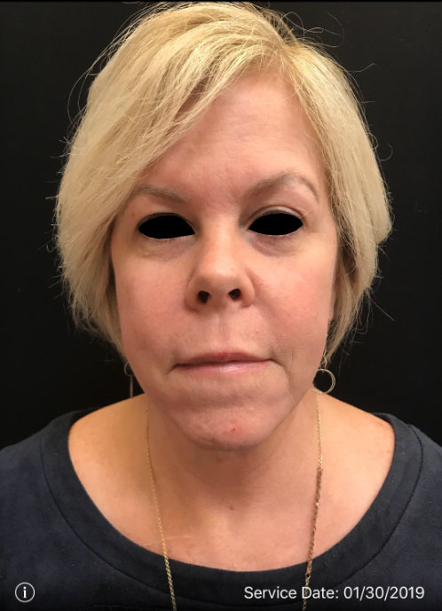 Facetite