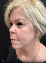 Facetite