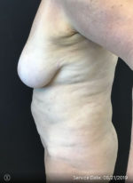 Breast Implant Removal