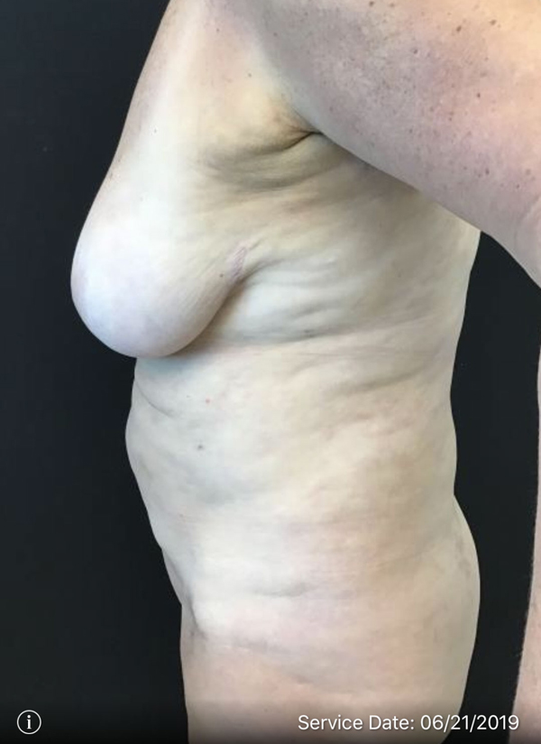 Breast Implant Removal