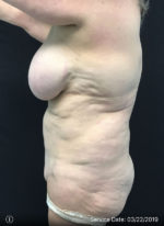 Breast Implant Removal