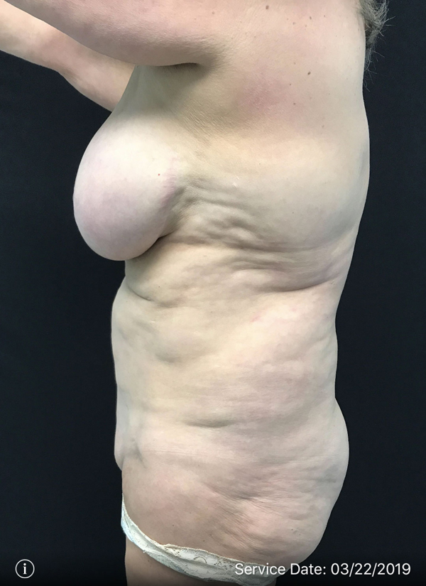 Breast Implant Removal