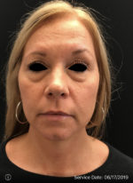 Around The Eye Fillers