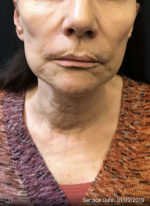 Facetite