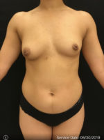 Fat Grafting to Breast