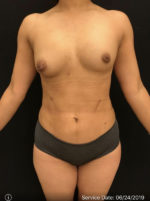 Fat Grafting to Breast