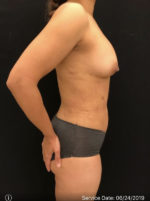 Fat Grafting to Breast