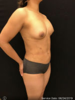 Fat Grafting to Breast