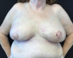 Breast Reconstruction