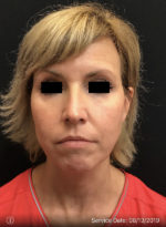 Facetite
