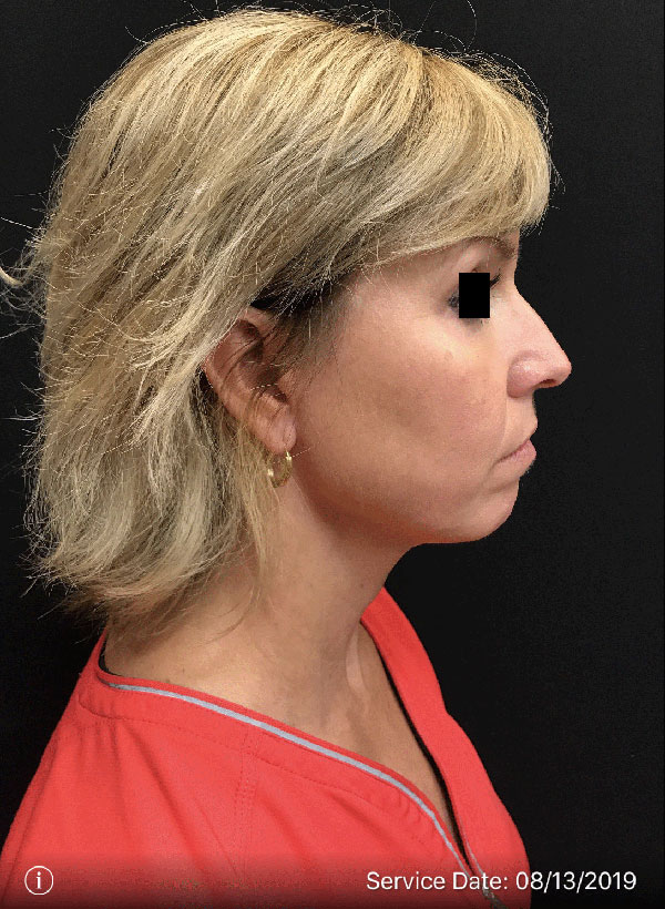 Facetite