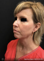 Facetite