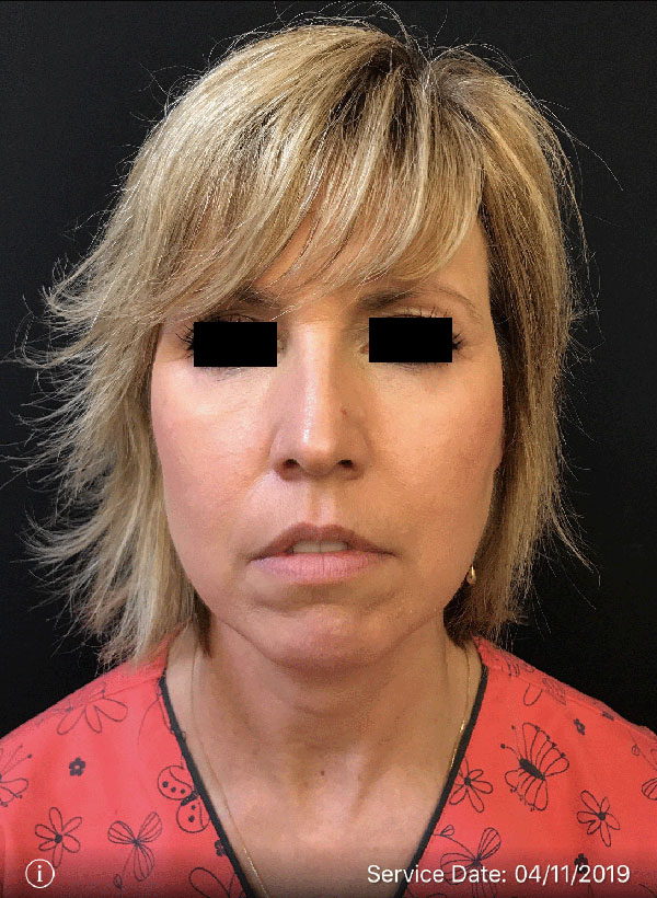 Facetite